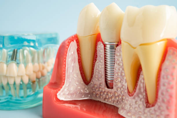 Best Dental Implants  in Sloan, NY